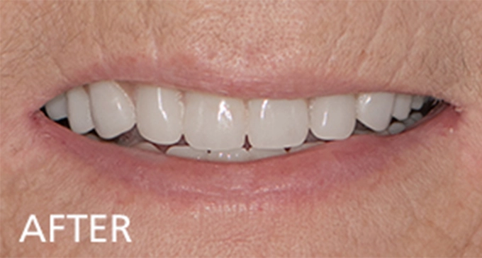 close up view after cosmetic dentistry showing a complete smile restoration with bright white upper teeth