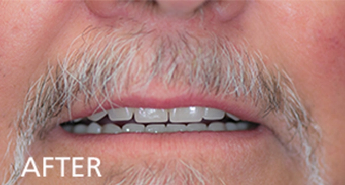 close up view after dental restoration showing a man with a mustache and a straight white clean smile