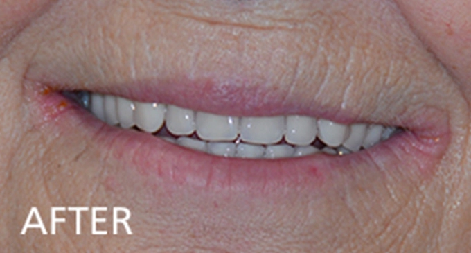 close up view after dental treatment showing a restored smile with straight bright white upper teeth