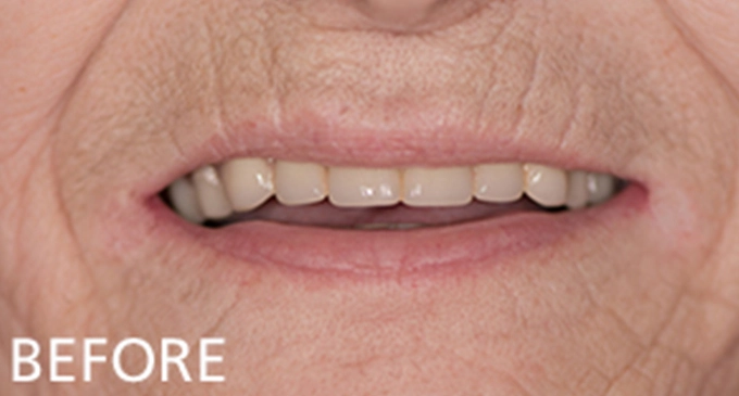 close up view before cosmetic dentistry showing worn shortened and discolored upper teeth