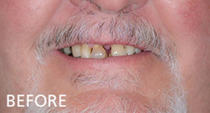 close up view before dental restoration showing a man with a mustache discolored teeth and visible tooth gaps