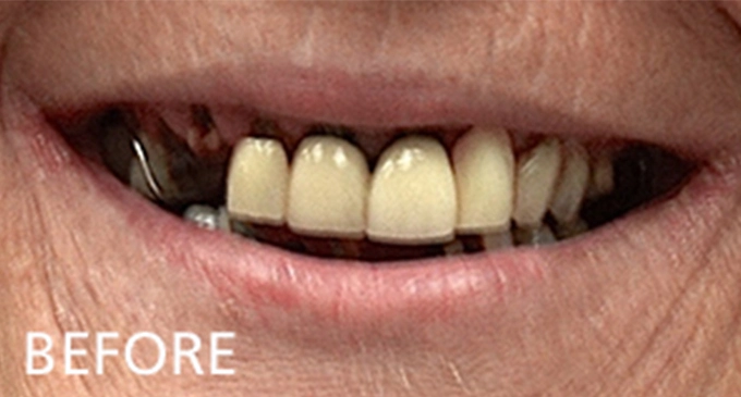 close up view before dental treatment showing damaged worn teeth with missing molars and metal denture clips